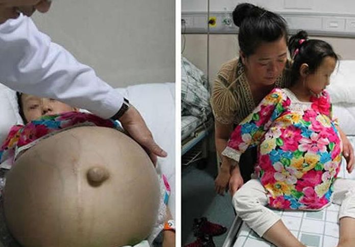 12岁的女孩肚子大了7个月不敢说,进行剖腹后,家长心疼不已