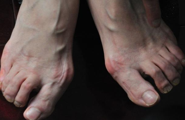 肺癌早期脚趾变化图片图片