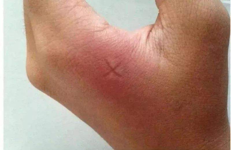 那么多人为什么蚊子只咬你