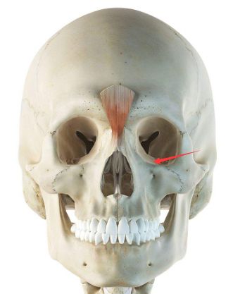 天生的原因,还有一个促使朴信惠眼袋增大的因素,既下方眼眶骨轻微凹陷