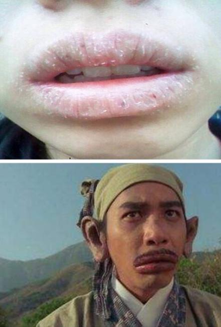 这就是西医讲的"慢性唇炎",中医称之为"唇风".