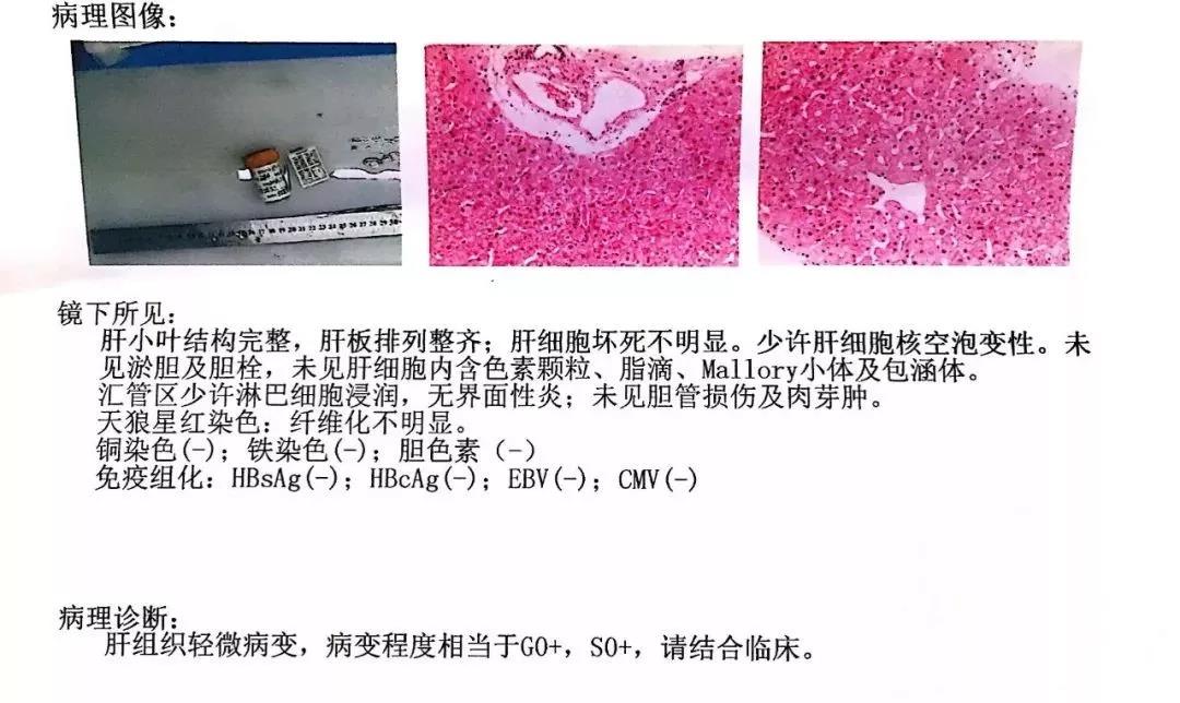 45kpa,為正常肝臟硬度值範圍.