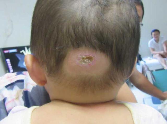 宝宝的耳朵长了血管瘤怎么办?耳部血管瘤怎么治疗?