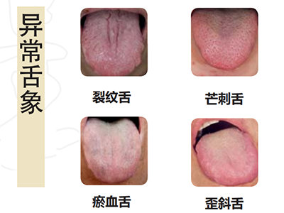 舌根芒刺图片图片