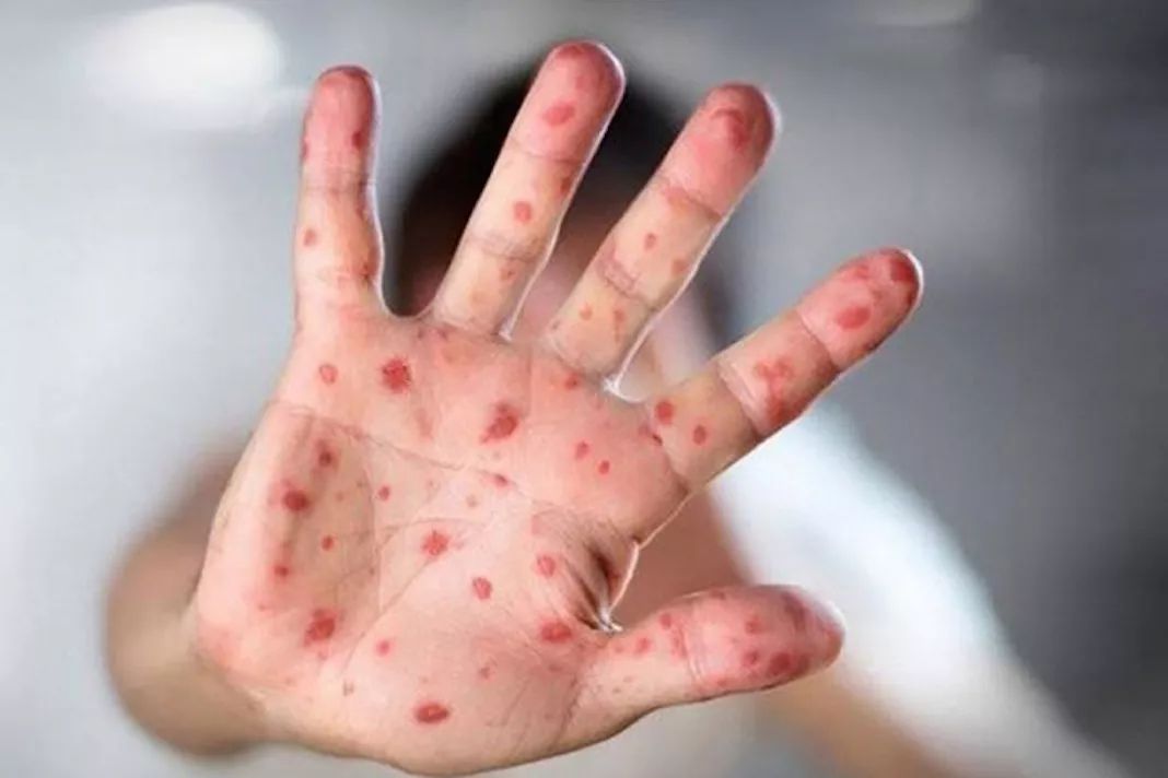 关注 会死人,传染性远超埃博拉,卑诗麻疹疫情有多重?接种疫苗权威指南