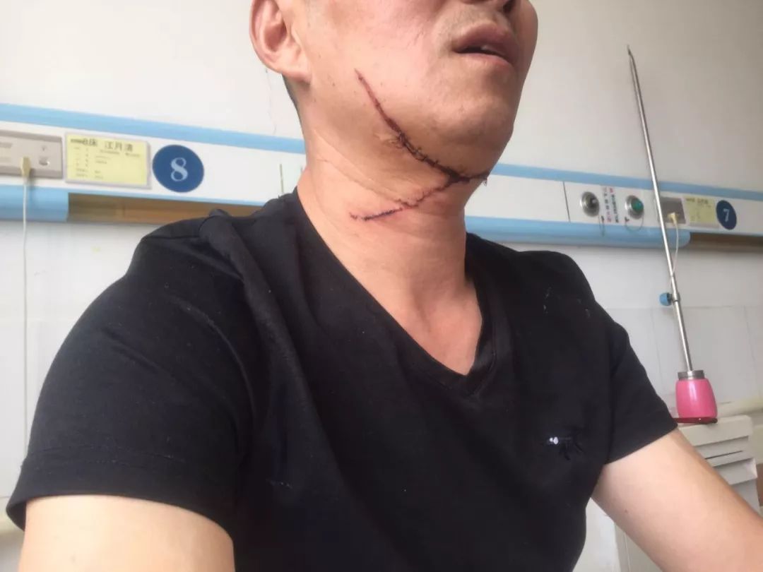 淮安一男子喉咙被割,伤口30厘米,缝了14针!