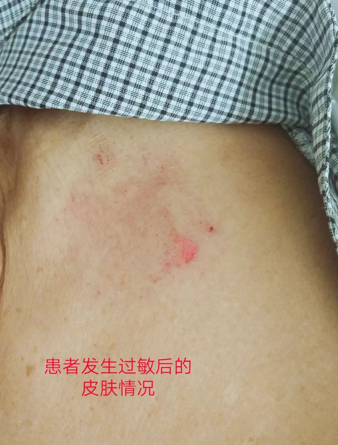 电极片过敏致皮肤破溃这样改良实特高明一箭双雕