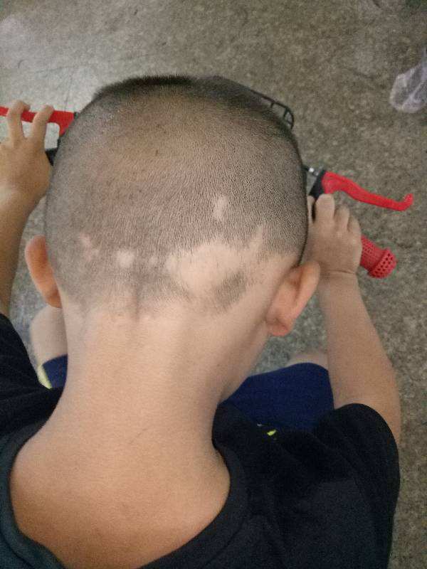 是什么原因引起儿童斑秃如何预防儿童斑秃斑秃五
