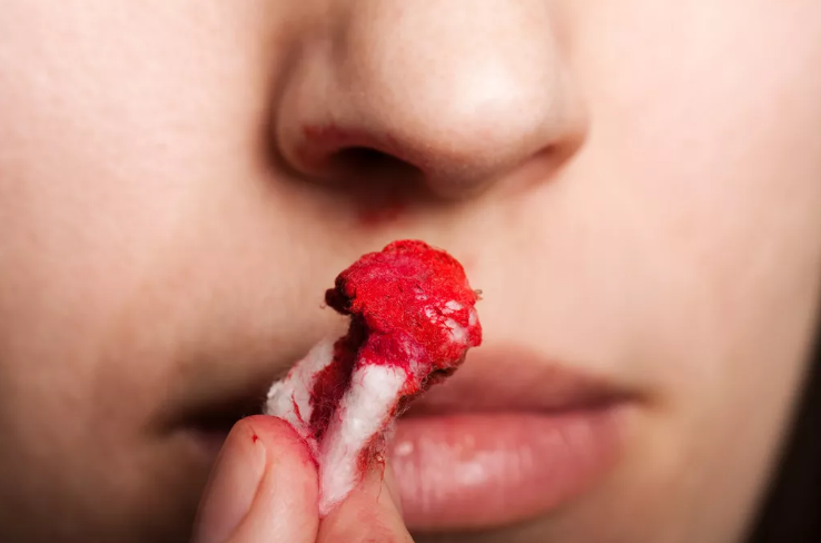 经常流鼻血小心鼻咽癌