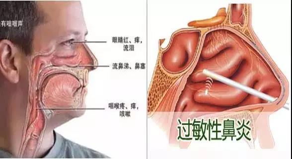 變應性鼻炎的典型症狀主要是陣發性噴嚏