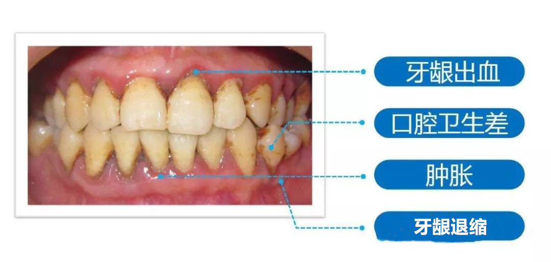高伟丽详解牙周病是怎么一步步侵害牙周牙齿健康的