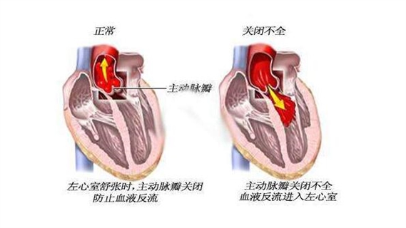 肺动脉瓣反流图片