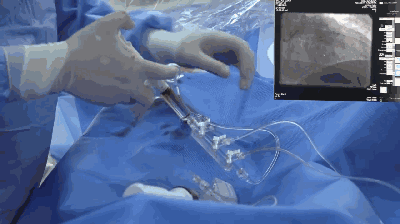 主动脉病,心力衰竭,急性心肌梗死等患者可以通过冠脉造影检查来确认