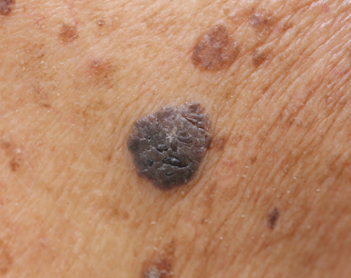 皮肤若有这5个特征,癌症已悄悄"袭"来__凤凰网