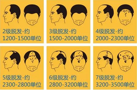 比方说,你选择在a医院做一台植发手术(一般患者种植超1000毛囊单位才