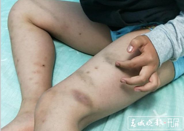 没做作业云南7岁男童被老师打到双腿多处淤青官方已处分
