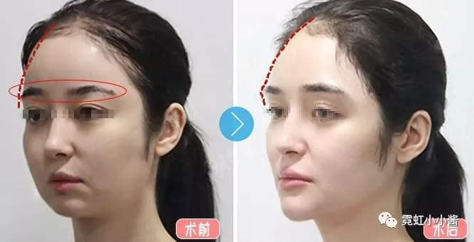 垫眉骨是个又疼又没效果的手术?那是因为你没长AB的脸__凤凰网