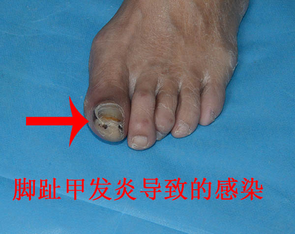 有图有真像糖尿病足早期症状一旦发现要及早治疗
