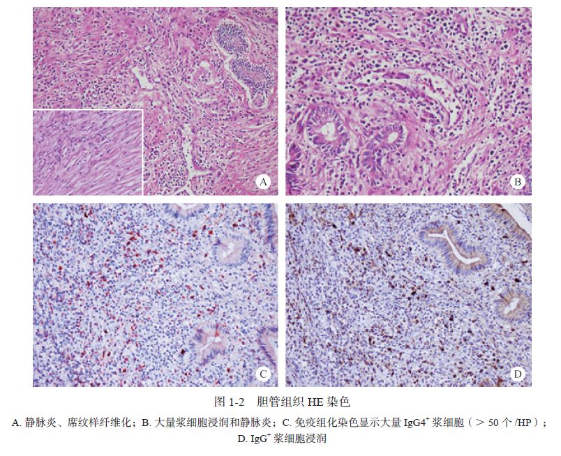 IgG4相关硬化性胆管炎重叠自身免疫性肝炎1例｜肝脏疾病疑难与经典病例（第四辑）__凤凰网