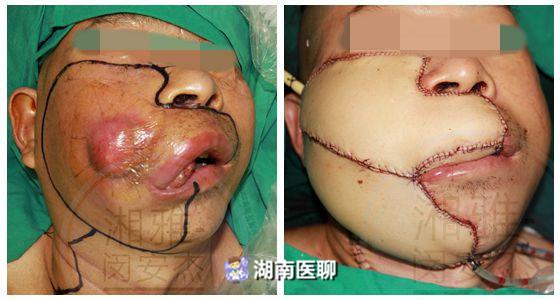 男子嘴里黄豆大小坨2个月长满半边脸疼痛难忍狂瘦20斤