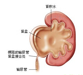 肾积水.jpg