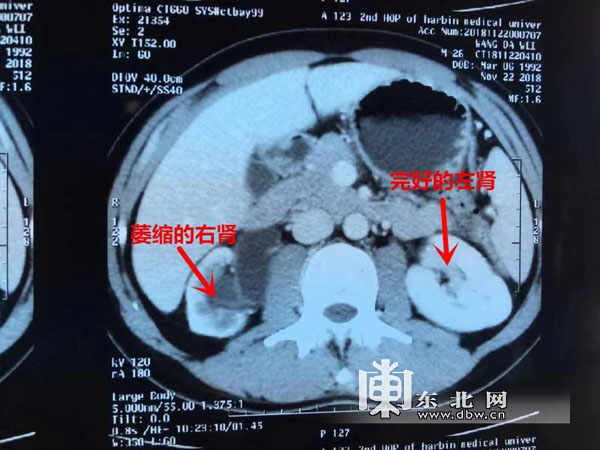 26歲小夥右腎萎縮了原來是先天性腎盂和輸尿管交界狹窄