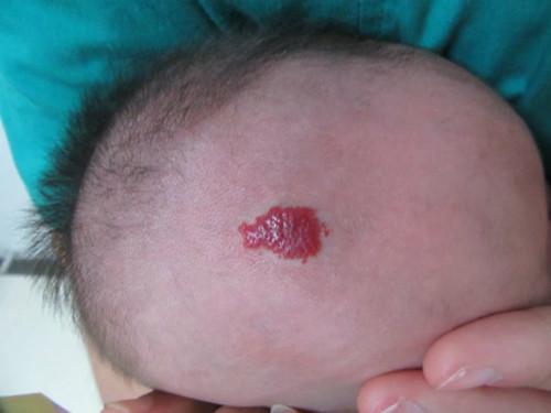 你知道婴儿血管瘤吗?宝宝出生后身上出现了血管瘤怎么办?