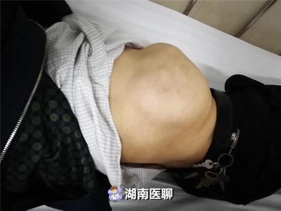 男子肋骨上长排球大小肿瘤3d打印定制钛网肋骨重建胸廓