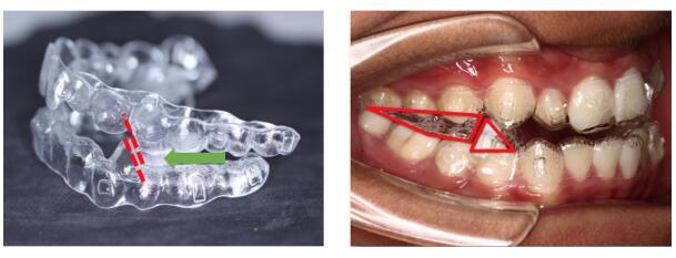 a6矫治器是在后牙区形成颌垫,打开咬合,通过上下颌(牙合)垫之间的斜面