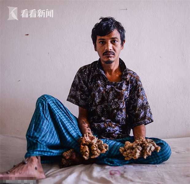 孟加拉国一男子患上了一种被称为"树人综合征"的罕见遗传病,由于手指