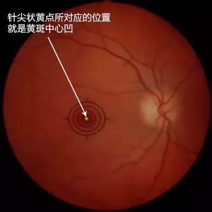 视网膜黄斑中心凹图片图片