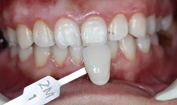 爱嗑瓜子的我,有了瓜子牙怎么办