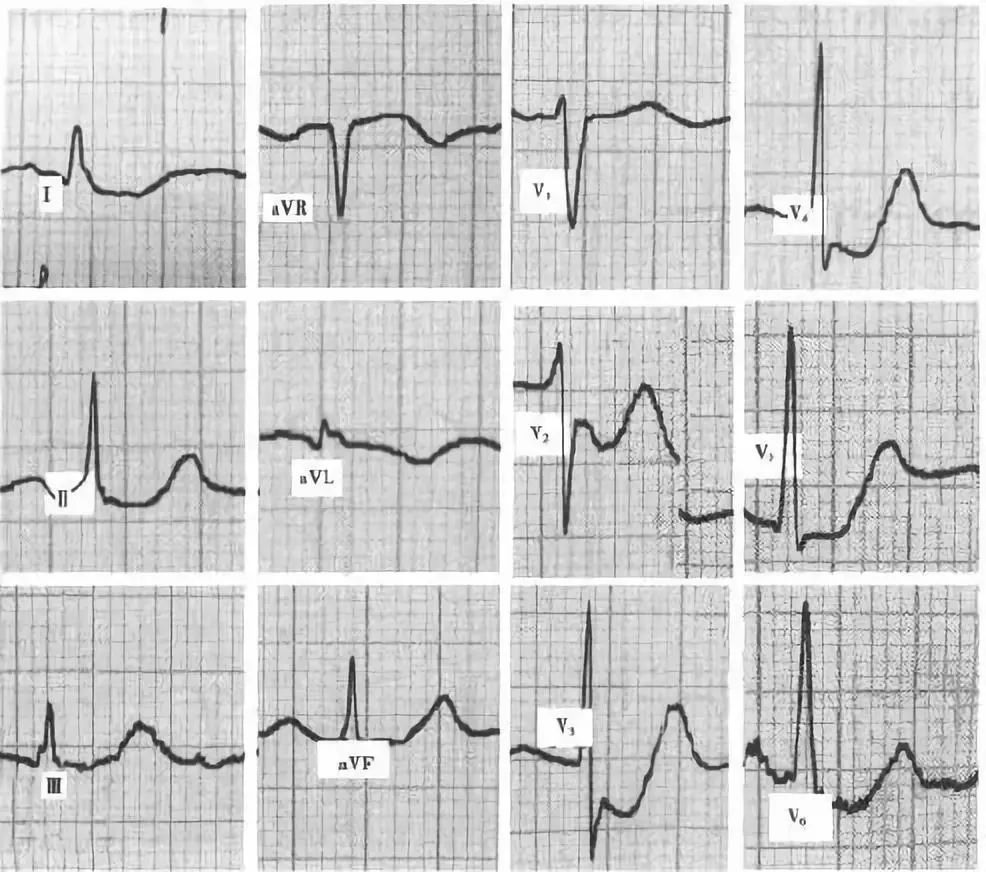 1 mv,伴或不伴t波倒置,且st-t變化至少持續24小時;心電圖無病理性q波