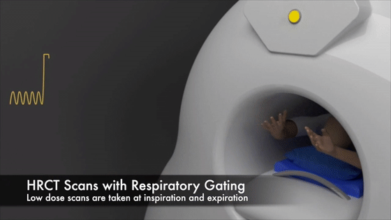 深耕肺病治疗materialise向肺部成像公司fluidda投资250万欧元