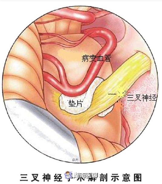 面部突发疼痛痛不欲生手术解除三叉神经痛医生在耳后开小口