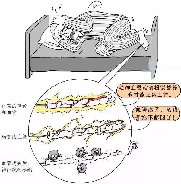 糖尿病神经病变