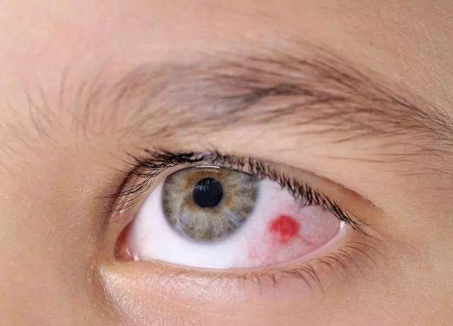 七成高血压患者有眼底改变,高血压已成眼睛"无形杀手",他们要怎么预防