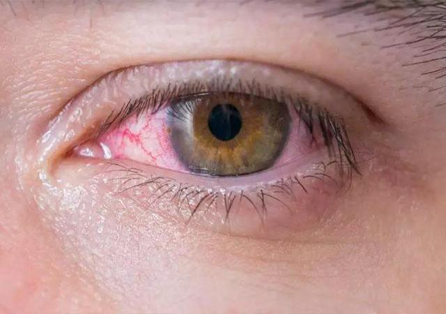 的血管才会扩张充血或者破裂,形成红血丝状,使我们的眼睛看起来发红