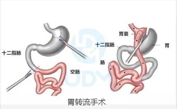 毕ll式手术图片