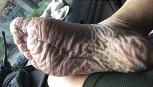 坑坑洼洼的伤痕一只脚满是褶皱出现这样一张照片浙江海宁人的朋友圈里