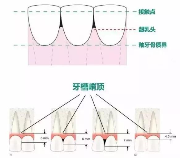 牙齿轴面角图解图片