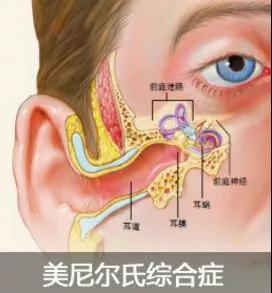 膜迷路积水图片