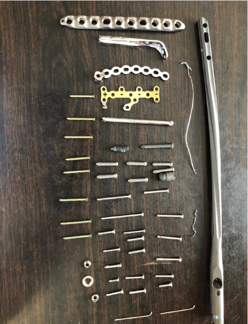 钢铁侠张云雷手术拆下的钢板钢钉铺满桌面网友看着都疼