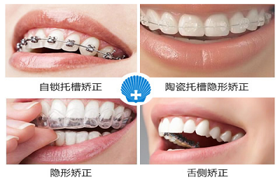 牙齿矫正后会反弹吗？深圳