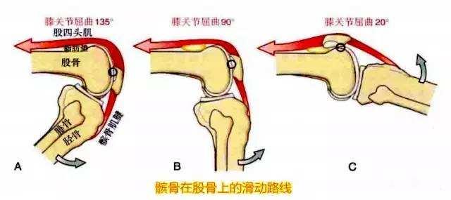 髕骨軟化症知多少二什麼是髕骨軟化症