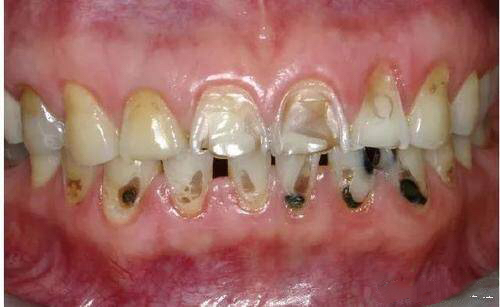 长期则形成环形缺损,牙齿不仅有冷热酸甜痛,还会有发黑变色,严重影响