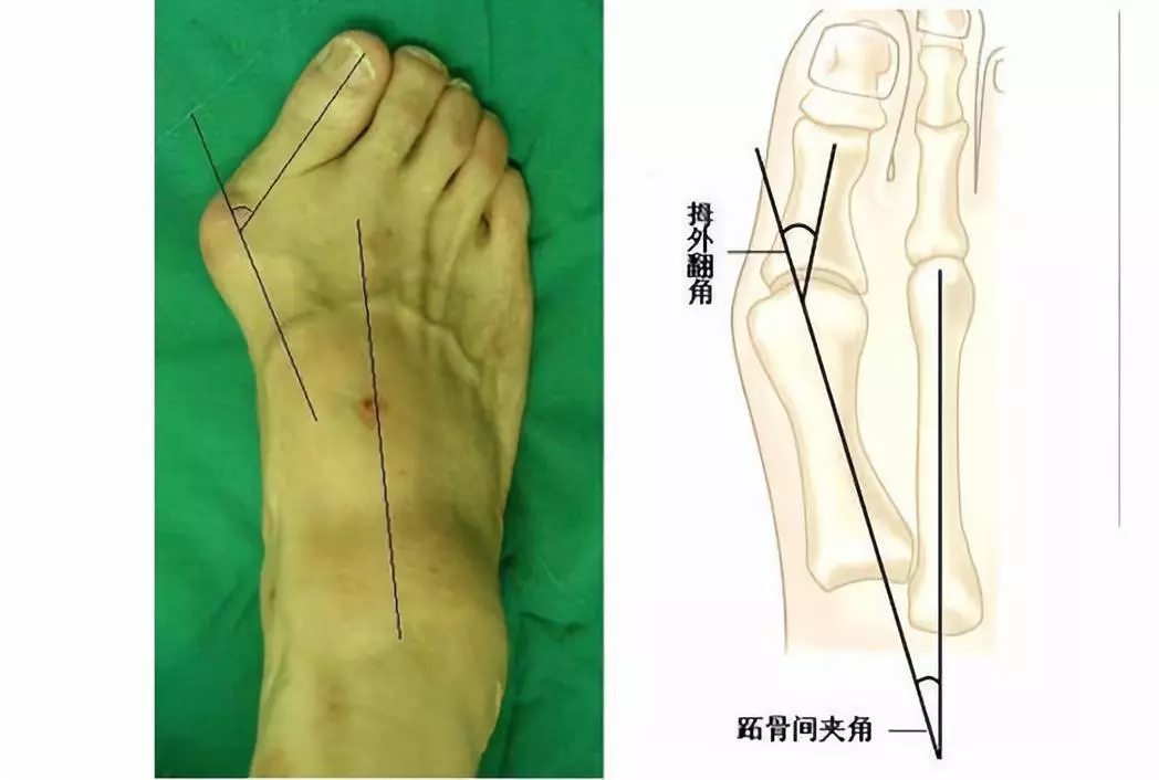 拇外翻不仅影响美,还会造成这些严重的后果如拇囊炎肿,足底筋膜炎,爪