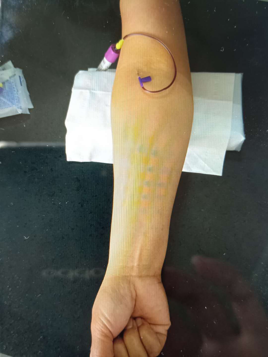 肘部静脉看不见这里有招快来看