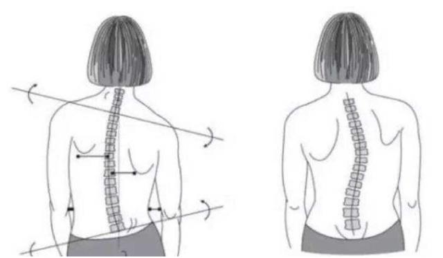 孩子高低肩長短腿怎麼辦脊柱專家孩子骨骼發育異常不能拖