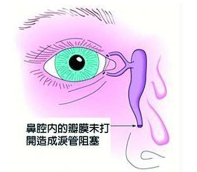 3个月宝宝成天眼泪汪汪?新生儿泪囊炎光靠眼药水可治不了!_凤凰网健康_凤凰网